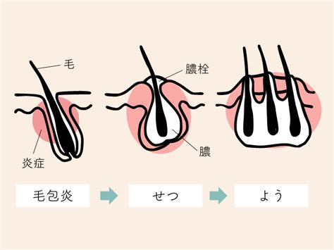 クリトリスにできもの|デリケートゾーン(陰部)のできもの｜ニキビ・しこり 